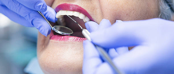 Best Emergency Wisdom Teeth Removal in Westchase, FL