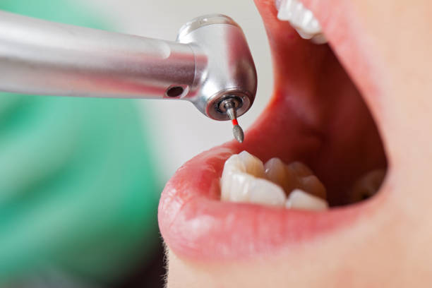 Best Emergency Dental Care for Broken or Chipped Teeth in Westchase, FL
